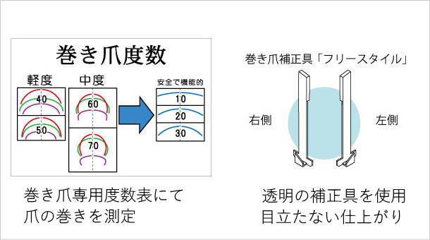 巻き爪
