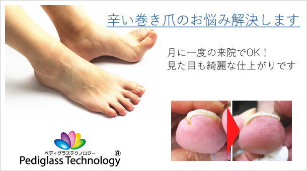 巻き爪